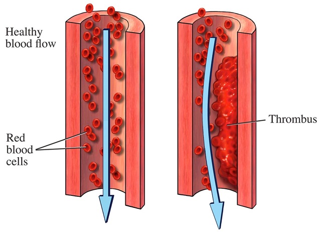Illustration of Normal Vein and Vein with Blood Clot